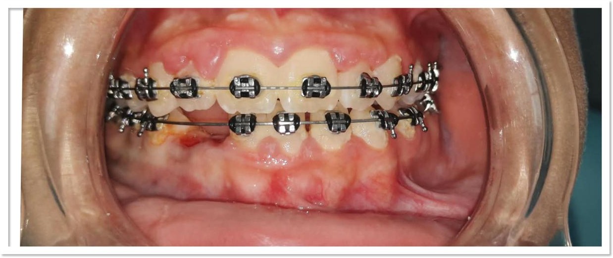 Alignement orthodontique — après