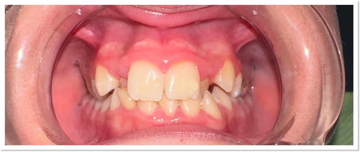 Alignement orthodontique — avant