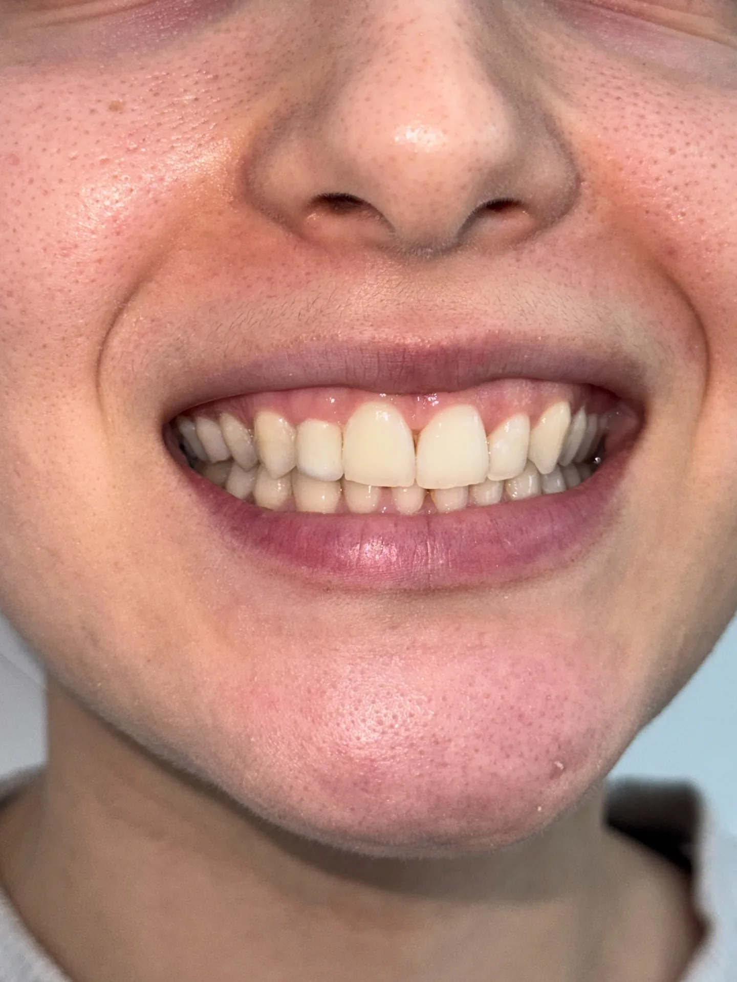 Sourire d'une patiente avant traitement esthétique